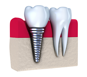 Dental Implants in Naples, FL
