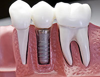 Dental Implants Napels, FL